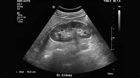 Kidney Ultrasound .